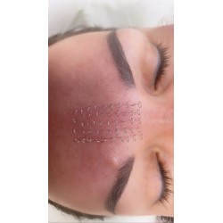 Pinezkowanie - akupunktura kosmetologiczna